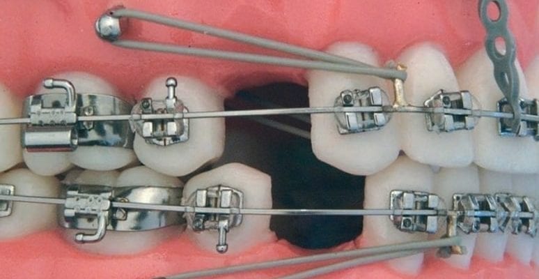 Ортодонтические микроимпланты: современные технологии в ортодонтии