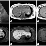 МРТ печінки: точна діагностика для оцінки стану органу