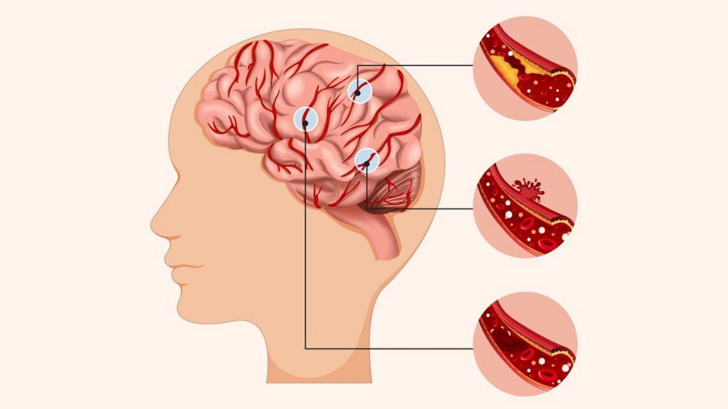 Нейропсихологическая реабилитация после инсульта: особенности, что предусматривает