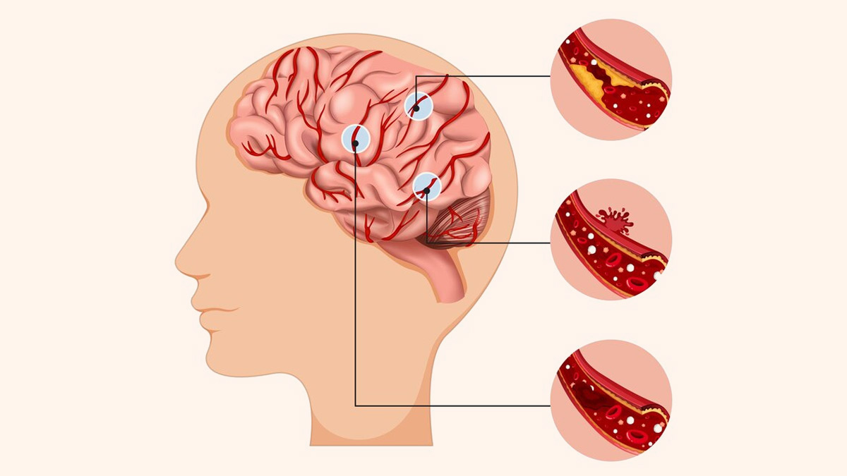 Нейропсихологическая реабилитация после инсульта: особенности, что предусматривает